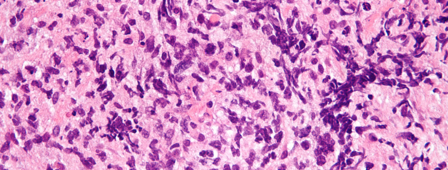 lymphoma b-cell magnification
